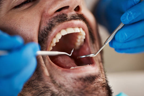 Best Emergency Dentist for Lost Fillings or Crowns in Plumsteadville, PA